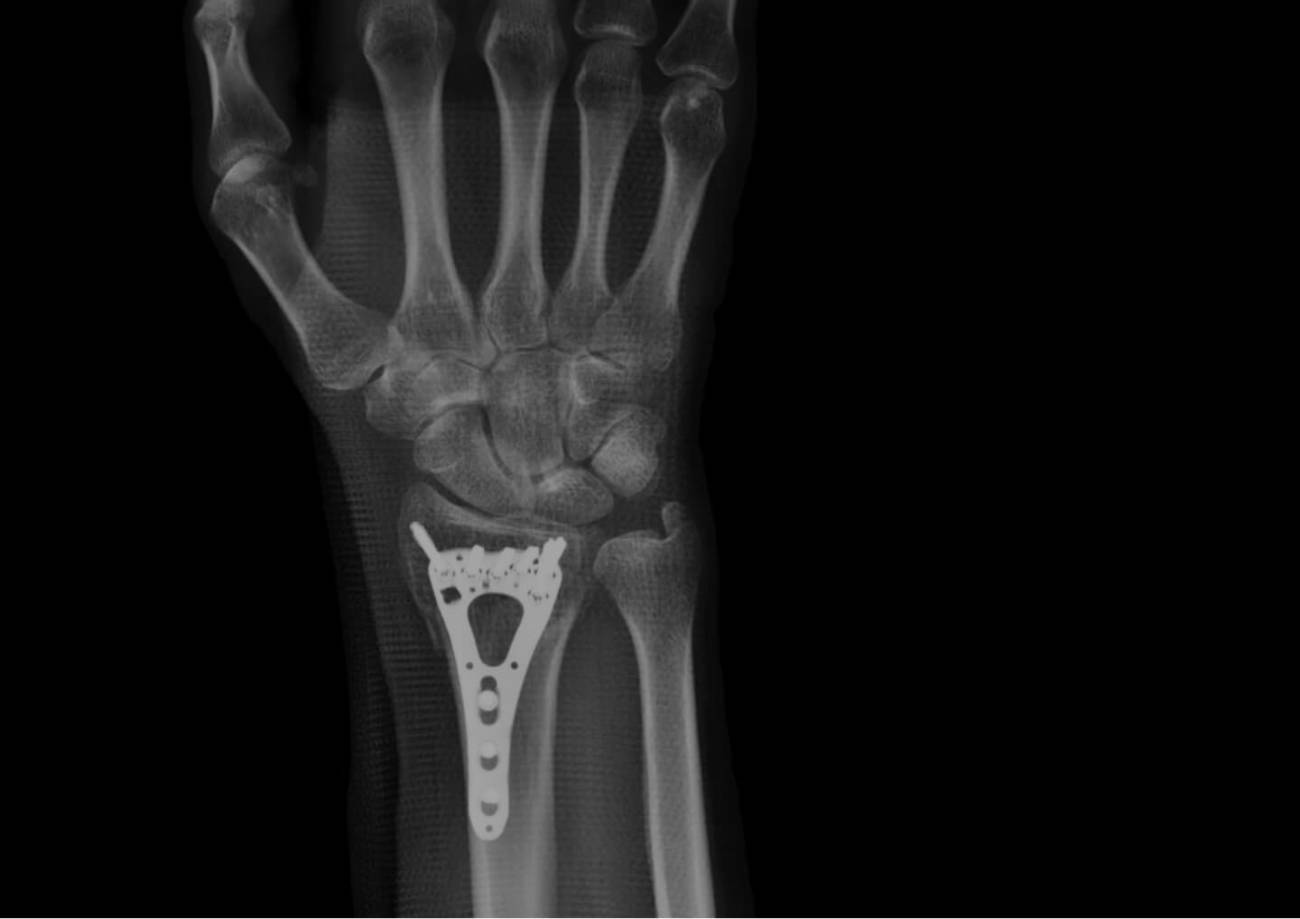 X-ray of a machined item inside of an arm.