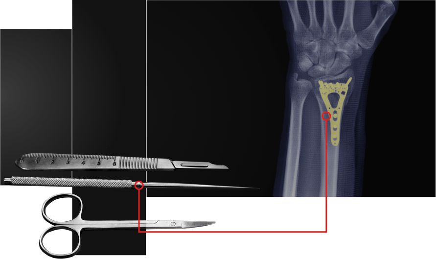 Medical instruments and an Xray of a machined part inside of an arm.